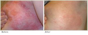 Excimer Laser for Psoriasis