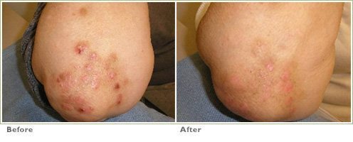 Excimer Laser for Psoriasis