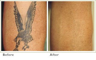 Tattoo Removal  Radiance Aesthetic Clinic