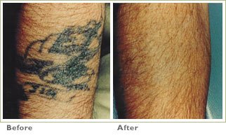 QSwitch Laser Tattoo Removal  Laser Tattoo Removal