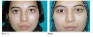 vitiligo6