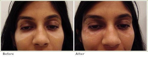 Excimer Laser for Vitiligo