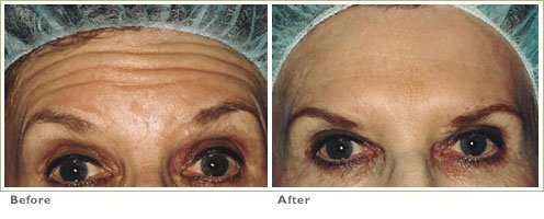 botox sacramento