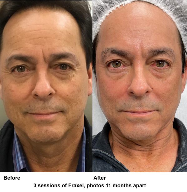Fraxel Laser For Pores - Laser Treatment to Shrink Pores