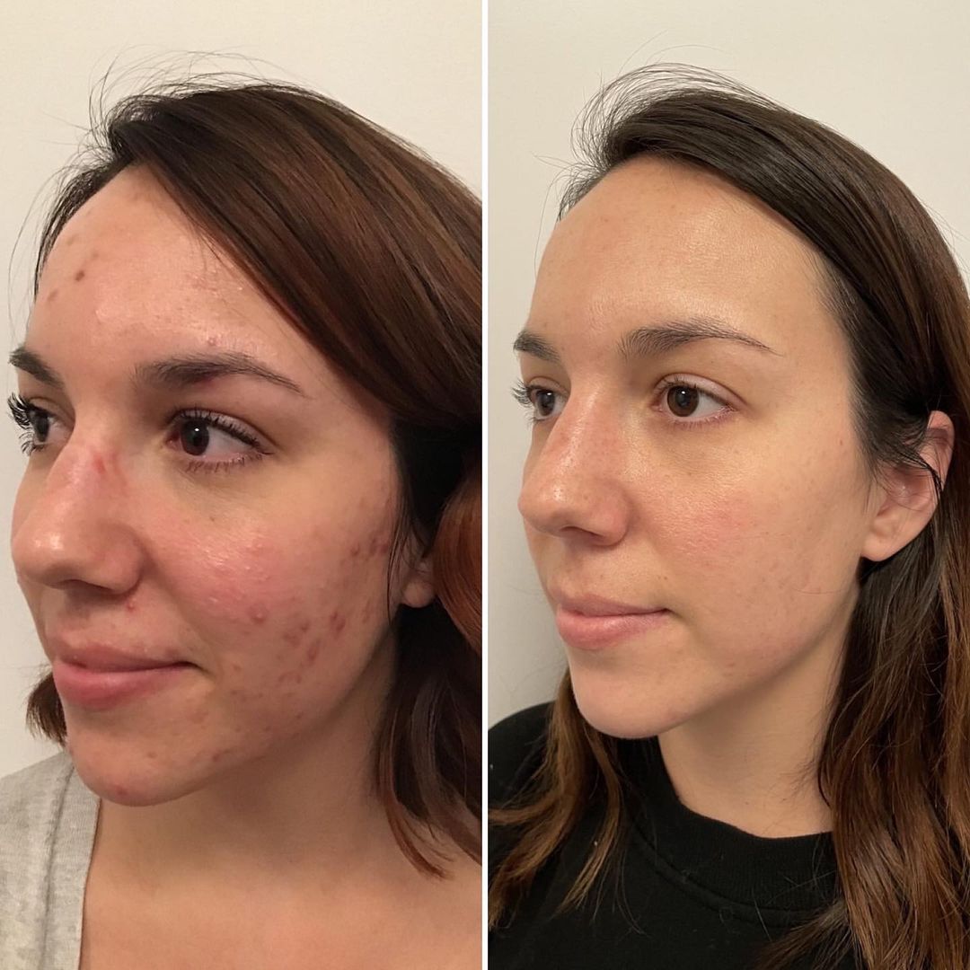 Before & After HydraFacial - Berman Skin Institute