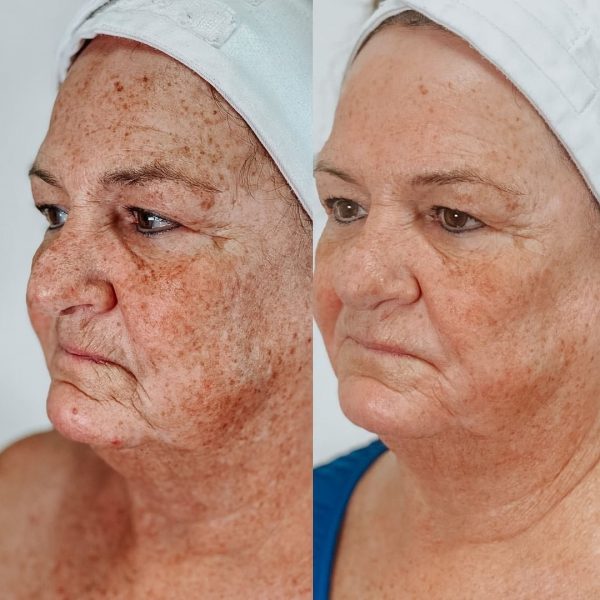 Before & After HydraFacial Berman Skin Institute