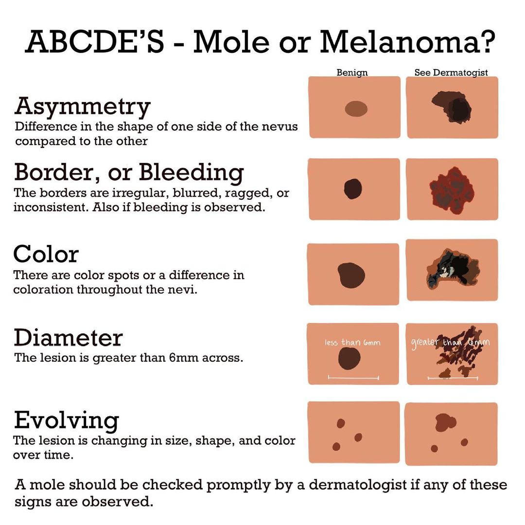 cancerous moles vs normal moles