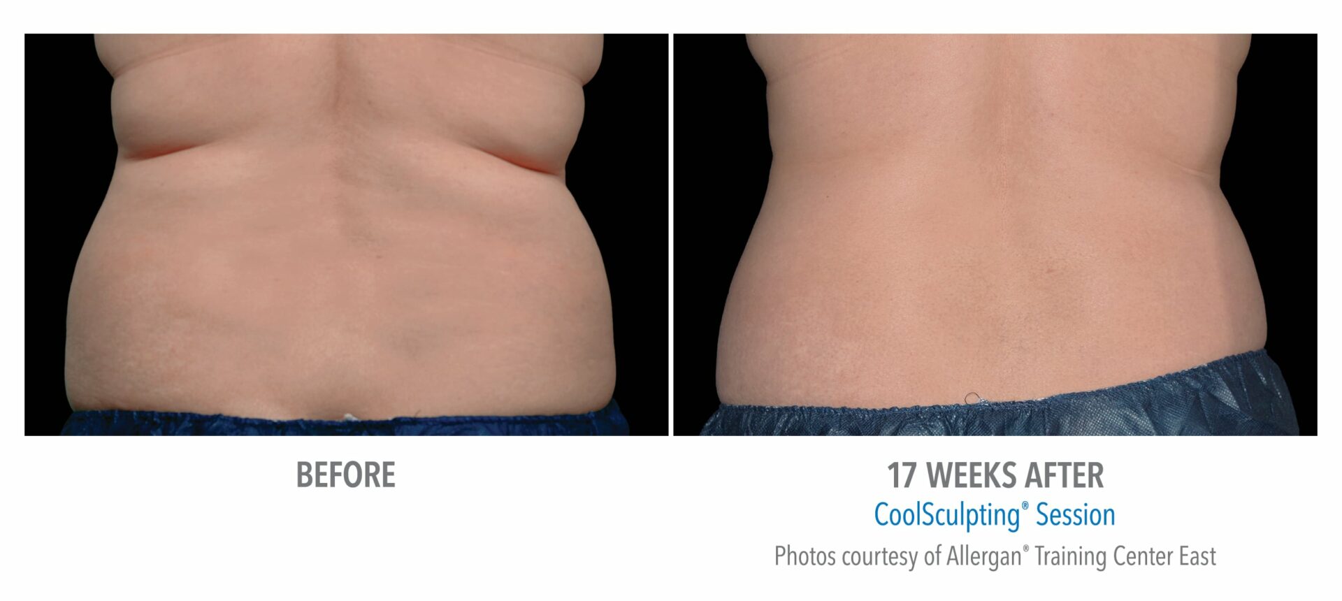 CoolSculpting Helps with Body Contouring - Berman Skin