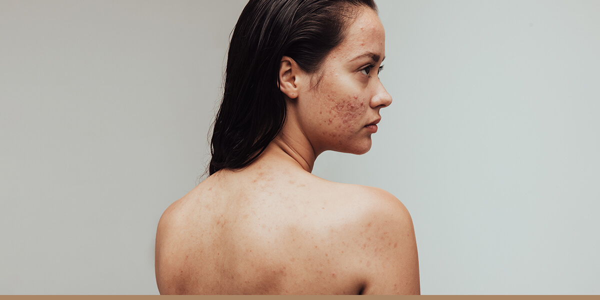 The Role of Photodynamic Therapy in Treating Acne and Other Skin Conditions 