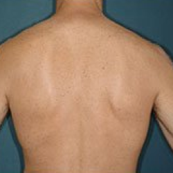 Smooth skin after laser hair removal