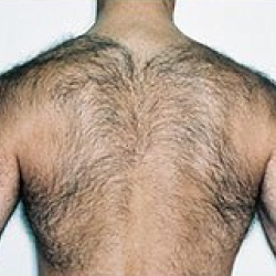 Skin before laser hair removal
