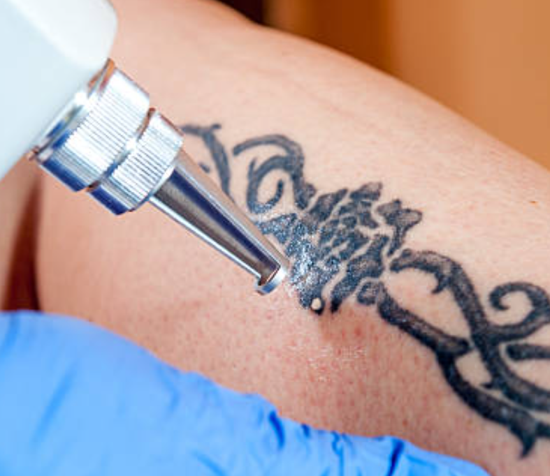 tattoo remove