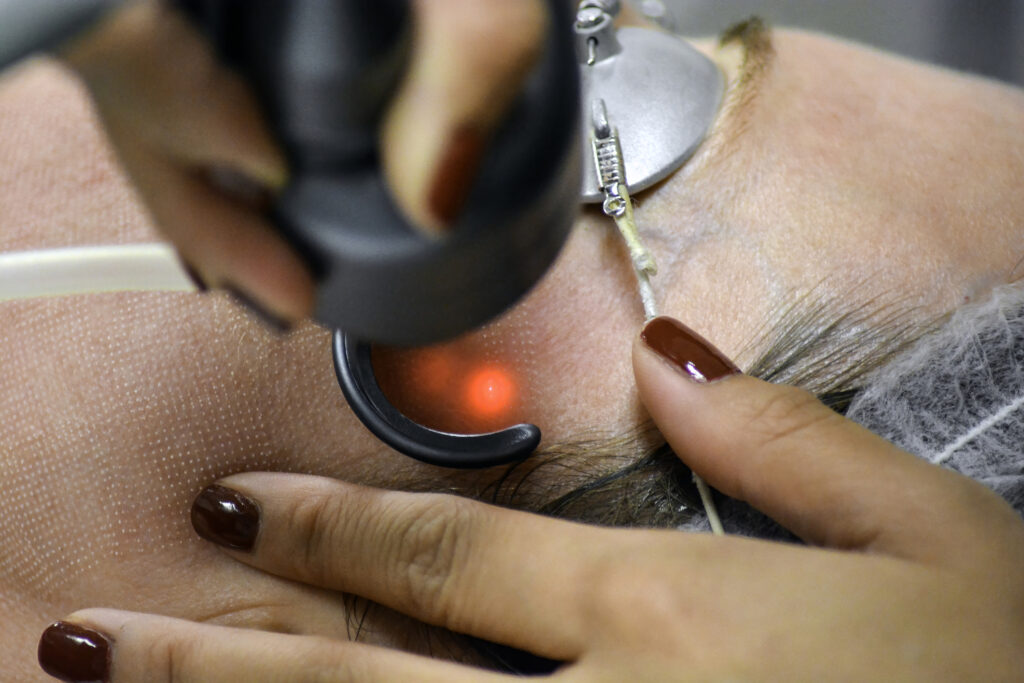 CO2 Fractional Laser Treatment